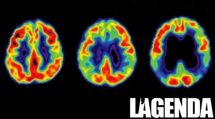 alzheimers