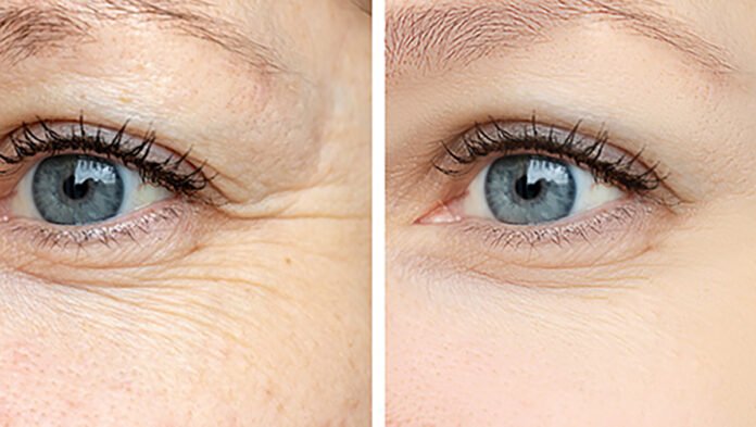 Biostimolazione